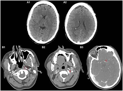 Case report: Navigating the challenges: successful mechanical thrombectomy in a case of persistent primitive hypoglossal artery